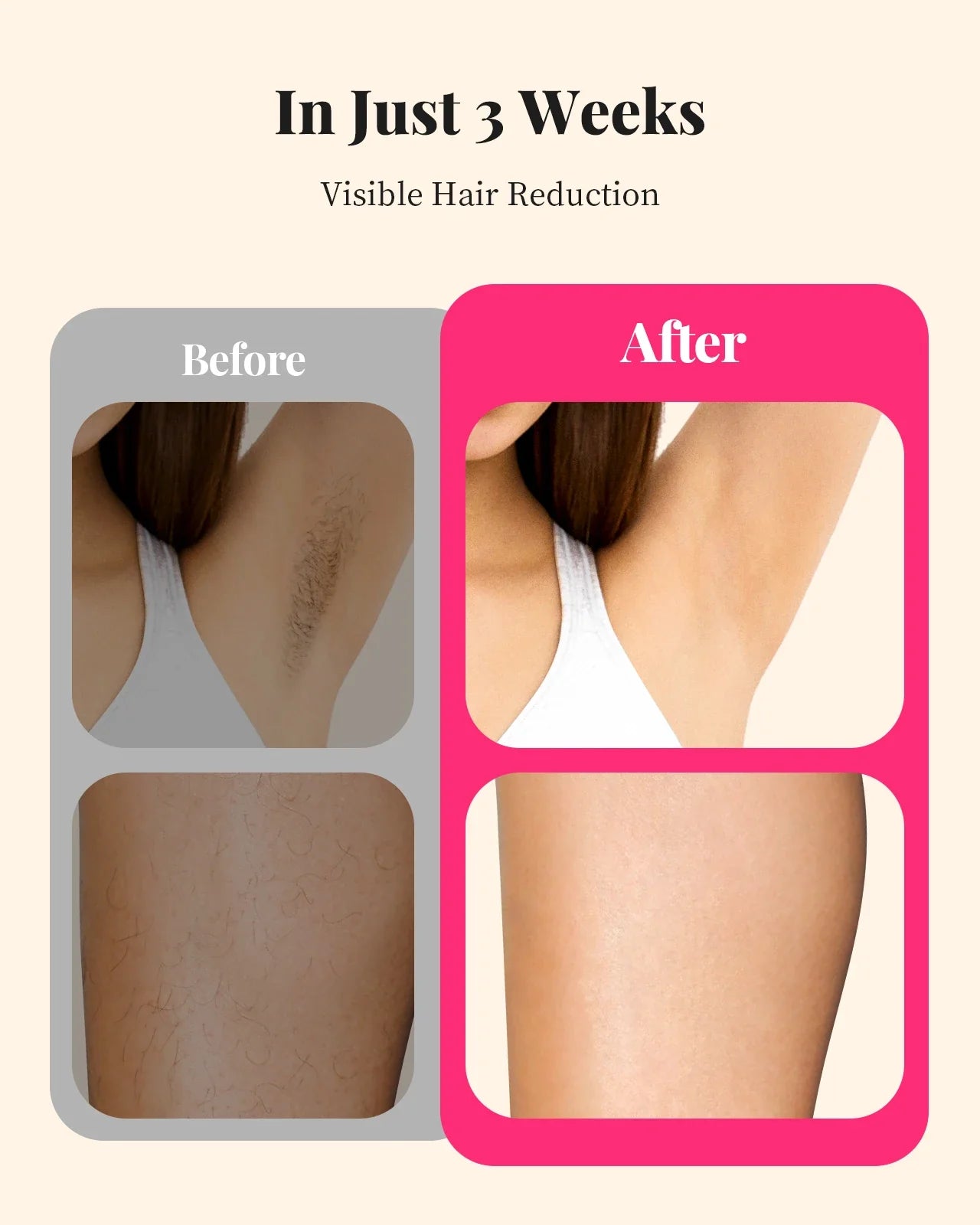 990,000 Flashes IPL Laser Hair Removal Device — Painless Permanent Hair Removal for Body, Bikini & Face