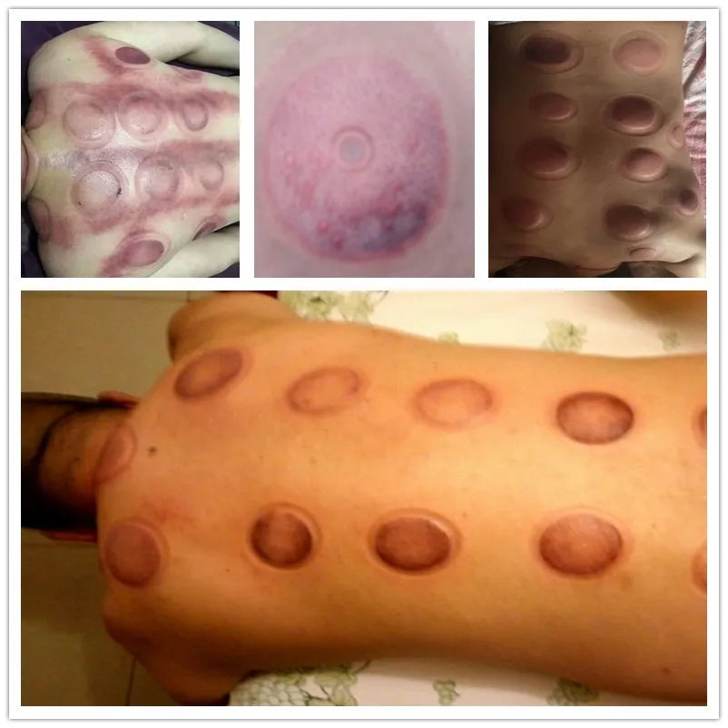 12pcs Magnetic Vacuum Cupping Set – TCM Suction Cups for Acupressure, Back Pain Relief & Body Massage Therapy