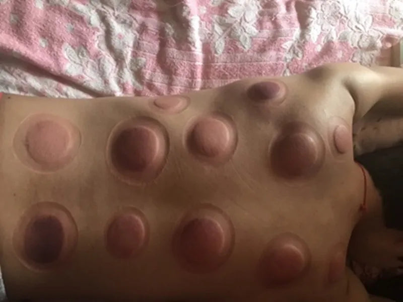 12pcs Magnetic Vacuum Cupping Set – TCM Suction Cups for Acupressure, Back Pain Relief & Body Massage Therapy