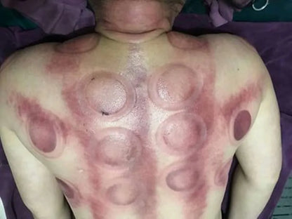 12pcs Magnetic Vacuum Cupping Set – TCM Suction Cups for Acupressure, Back Pain Relief & Body Massage Therapy