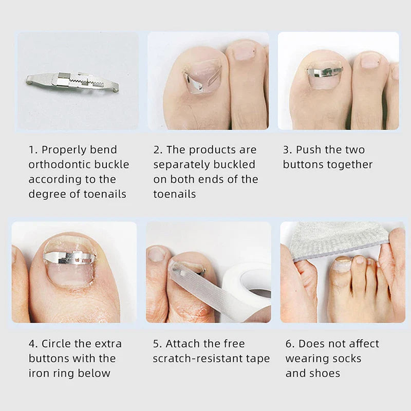 Professional Ingrown Toenail Corrector Tools - Pedicure Recovery, Embed Toe Nail Treatment, Foot Care Tool for Ingrown Toenail Correction