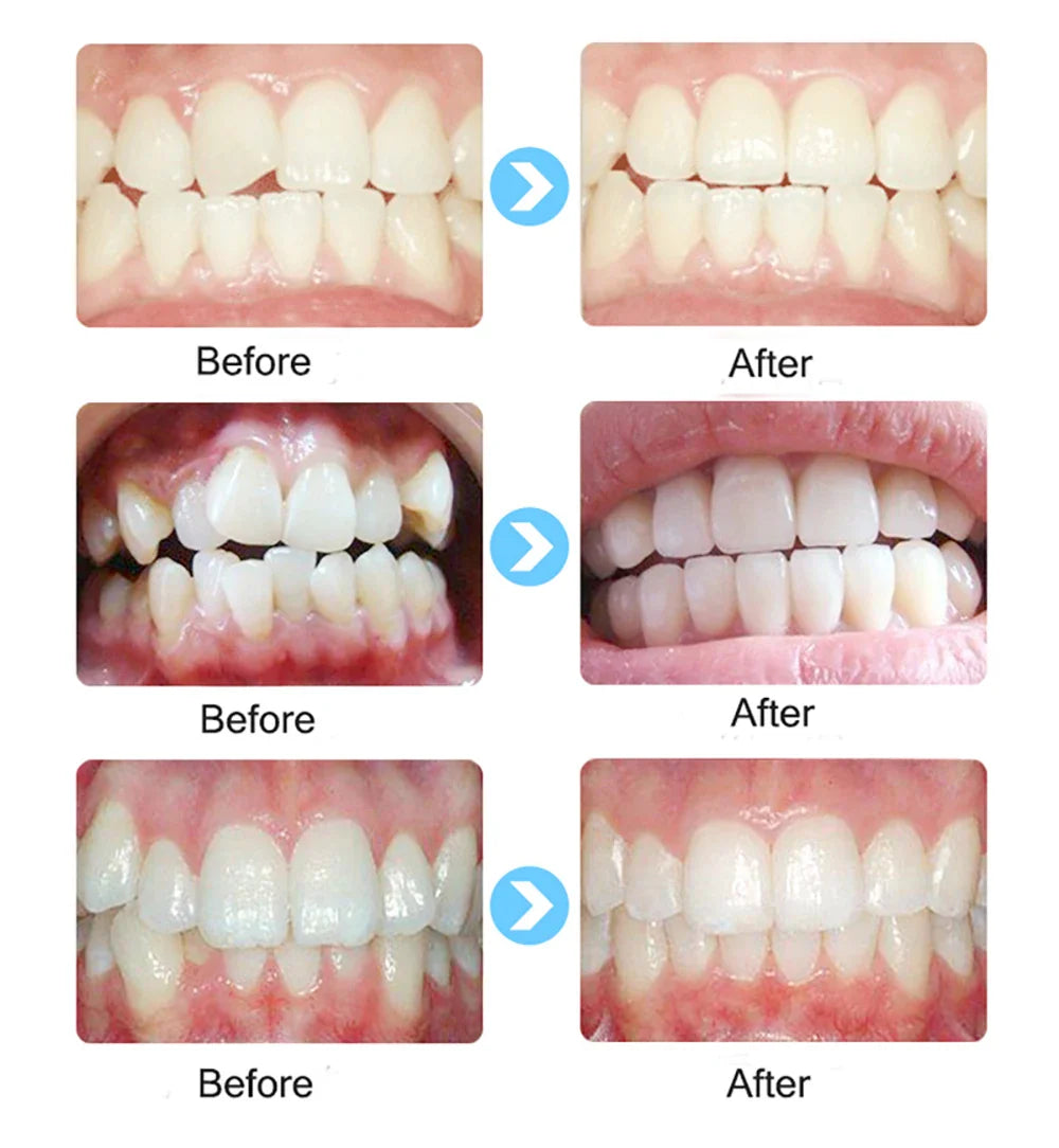 T4K Children’s Dental Tooth Trainer – Orthodontic Appliance for Kids Teeth Alignment, Soft & Hard Braces Mouthpieces