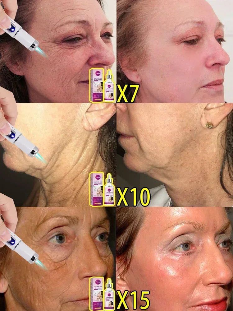 Laser Skin Treatment Device — Professional Solution for Facial Skin Problems
