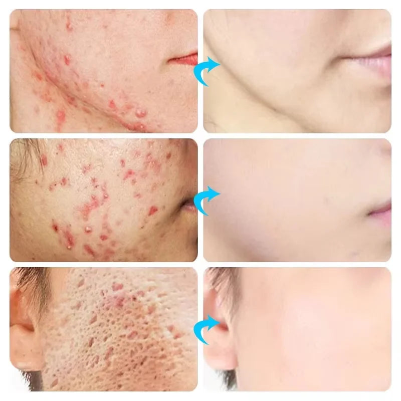 Effective Acne Removal Cream – Anti-Acne Gel for Redness, Pimples, Deep Pore Cleaning & Oil Control Skin Care