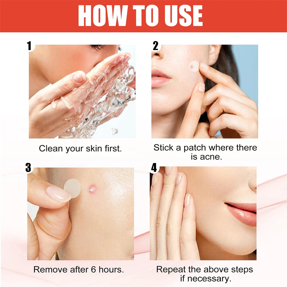 144pcs Face Acne Pimple Patch Set – 2 Sizes Invisible Professional Healing Spot Stickers for Men & Women Skin Care
