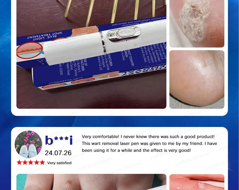 Safe Skin-Friendly Wart Removal Methods – Gentle Solutions for Effective Wart Treatment