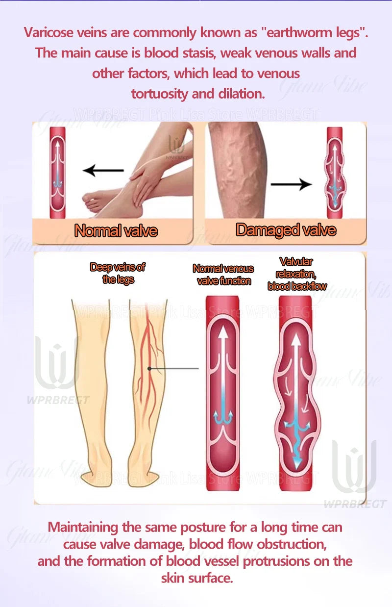 Varicose Vein & Spider Leg Pain Relief Treatment — Painless Care for Vasculitis & Phlebitis