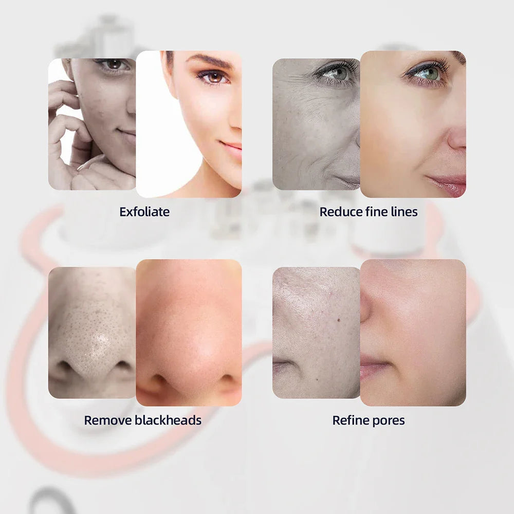 Foreverlily Diamond Facial Peeling Machine – Home Microdermabrasion & Nano Water Spray Exfoliator