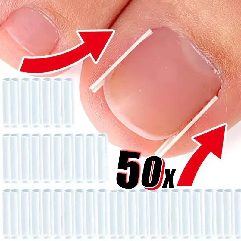 50PCS Ingrown Toenail Correction Kit – Invisible Nail Straightening Clips & Treatment Pads for Foot Care