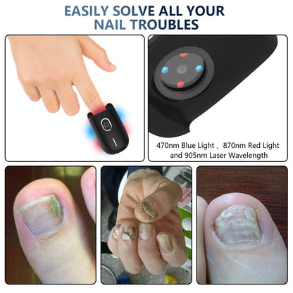 Fast Nail Fungus Repair with Fungal Nail Laser Device - Effective Onychomycosis Treatment