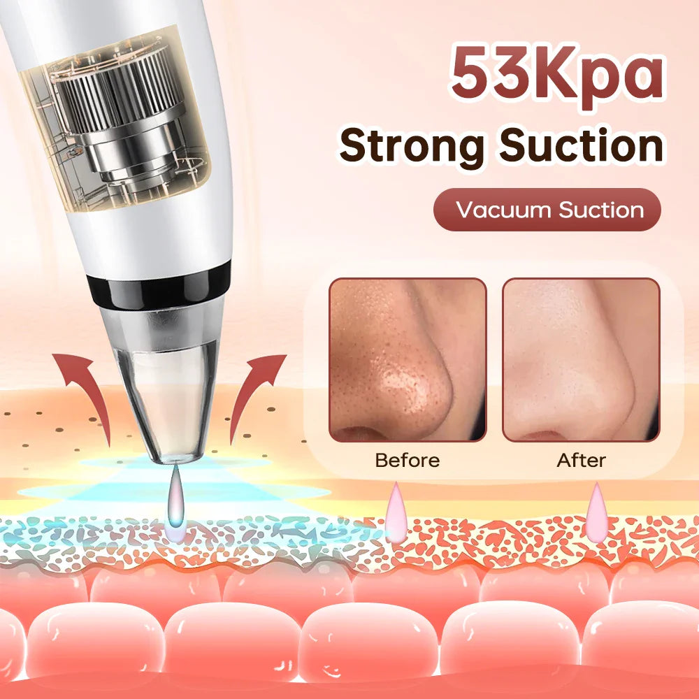 3-Mode Blackhead Remover Vacuum – Facial Pore Cleaner & Dead Skin Removal Beauty Tool