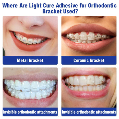 Dental Orthodontic Adhesive Kit — Light Cure Glue for Metal & Ceramic Brackets, Invisible Bonding Dentistry Tools