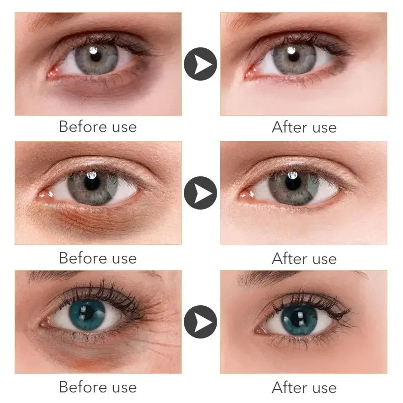 Micro-Needle Hyaluronic Acid Eye Patch – Anti-Wrinkle Moisturizing Eye Mask for Fine Lines Removal
