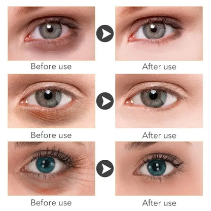 Micro-Needle Hyaluronic Acid Eye Patch – Anti-Wrinkle Moisturizing Eye Mask for Fine Lines Removal
