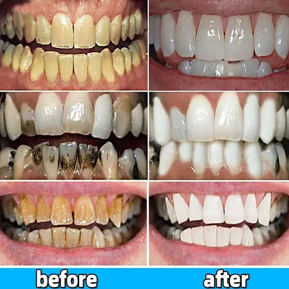 Dental Calculus Remover – Bad Breath & Whitening Teeth Care, Prevent Periodontitis & Brighten Smile