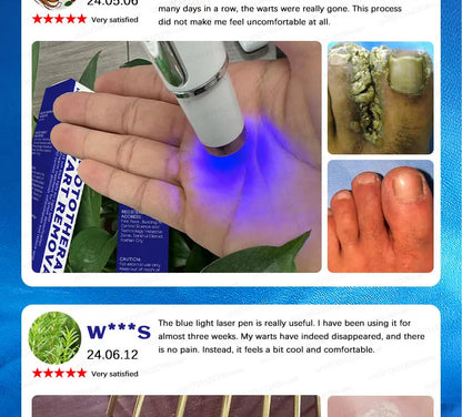 Safe Skin-Friendly Wart Removal Methods – Gentle Solutions for Effective Wart Treatment