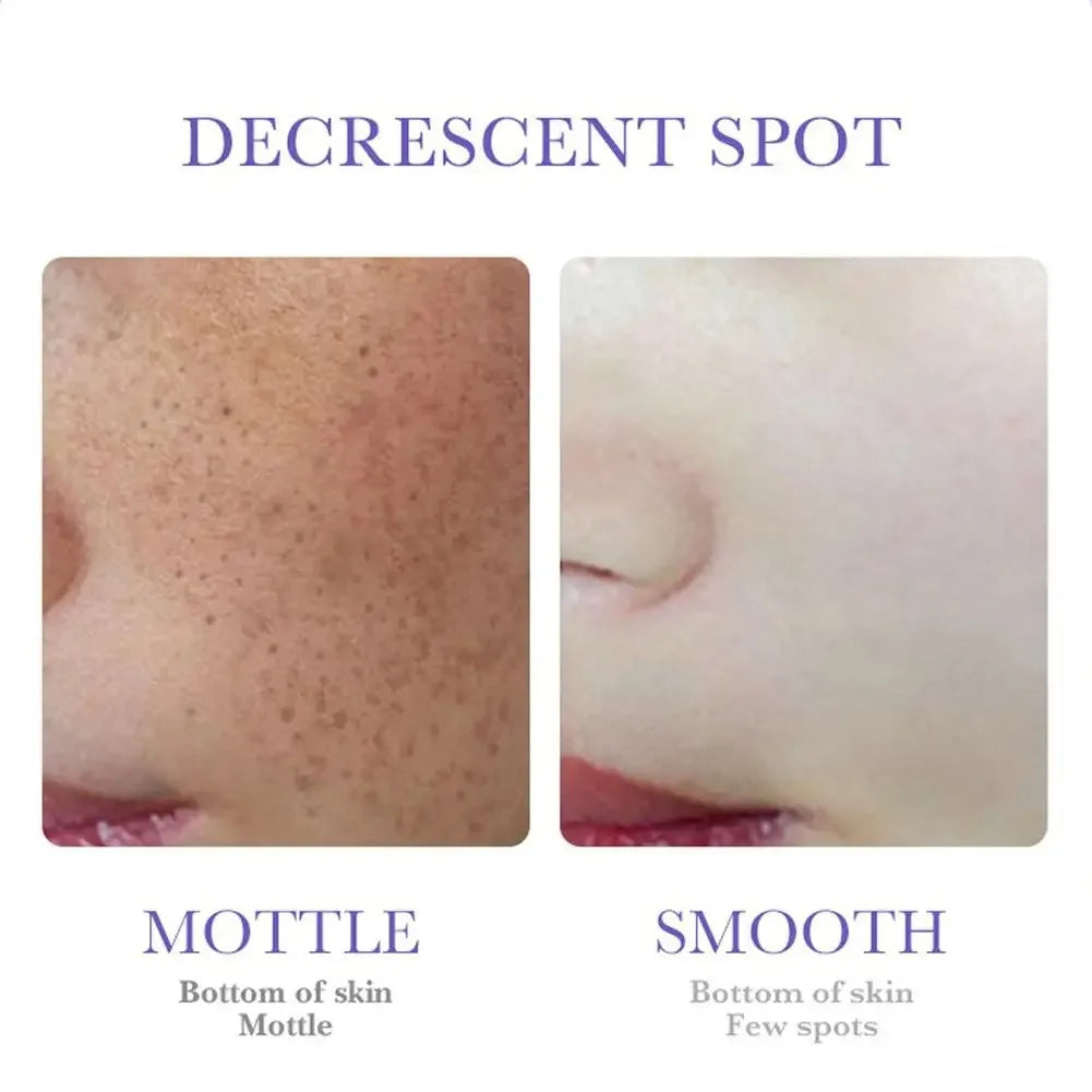SADOER Nicotinamide Freckle & Dark Spot Cream – Melasma Removal Whitening Face Cream for Brightening & Moisturizing Skin Care