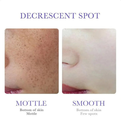 SADOER Nicotinamide Freckle & Dark Spot Cream – Melasma Removal Whitening Face Cream for Brightening & Moisturizing Skin Care