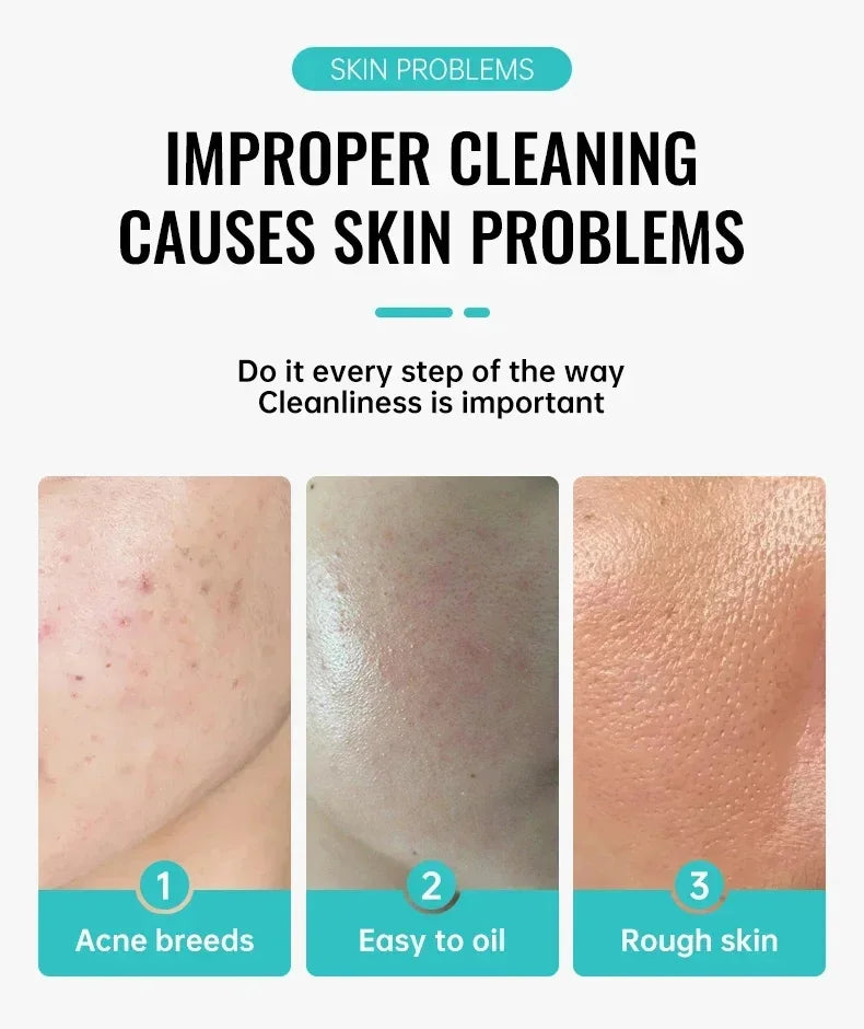 Salicylic Acid Acne Removal Cream – Anti-Acne, Redness Repair, Deep Cleaning & Oil Control Skincare