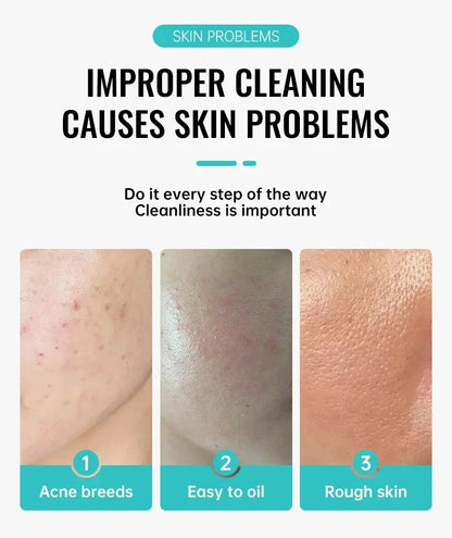 Salicylic Acid Acne Removal Cream – Anti-Acne, Redness Repair, Deep Cleaning & Oil Control Skincare