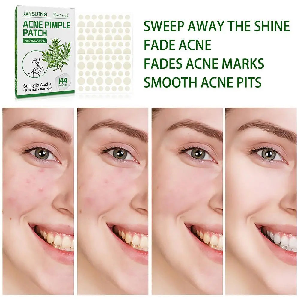144 Pack Acne Pimple Patches – Translucent Matte Hydrocolloid with Salicylic Acid & Tea Tree Oil for Whiteheads & Inflamed Acne