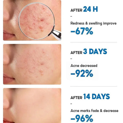 Salicylic Acid Acne Removal Cream – Anti-Acne, Redness Repair, Deep Cleaning & Oil Control Skincare