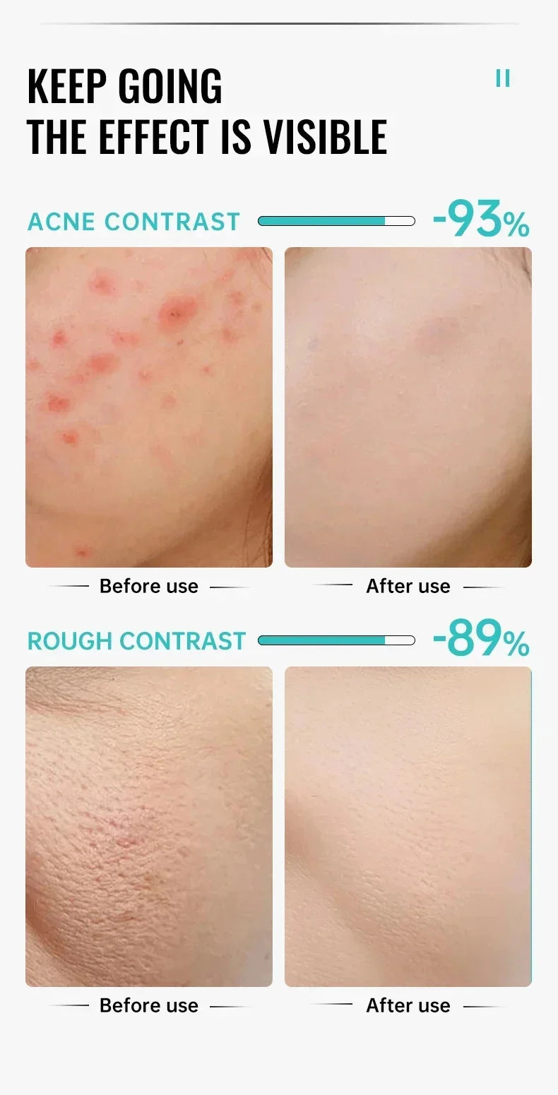 Effective Acne Removal Cream – Anti-Acne Gel for Redness, Pimples, Deep Pore Cleaning & Oil Control Skin Care