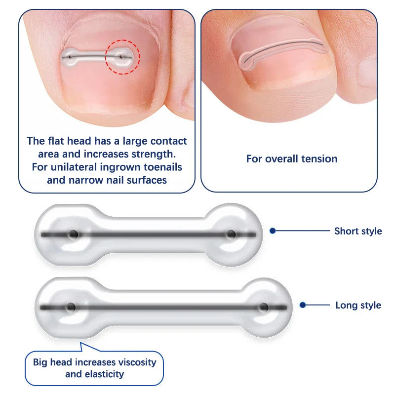 2-Piece Ingrown Toenail Correction Kit – Elastic Patch & Straightening Clip Pedicure Tool for Toe Nail Treatment