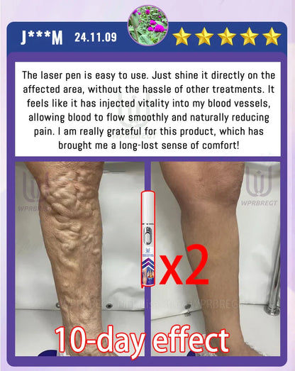 Varicose Vein & Spider Leg Pain Relief Treatment — Painless Care for Vasculitis & Phlebitis