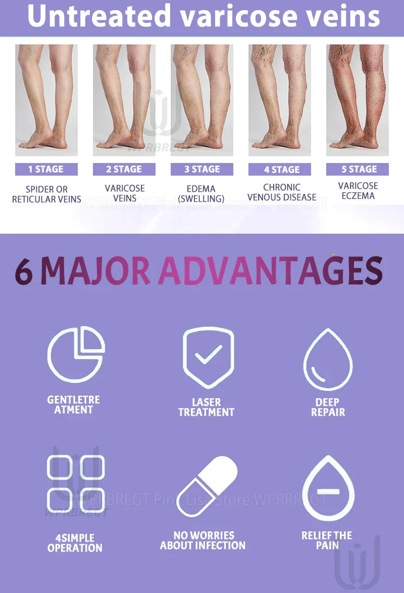 Varicose Vein & Spider Leg Pain Relief Treatment — Painless Care for Vasculitis & Phlebitis