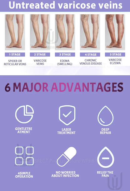 2nd Gen Varicose Vein Laser Therapy Device – Relieves Spider Leg Pain, Treats Vasculitis & Phlebitis
