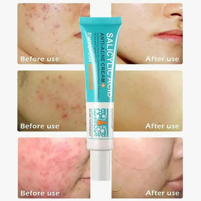 Salicylic Acid Acne Removal Cream – Anti-Acne, Redness Repair, Deep Cleaning & Oil Control Skincare