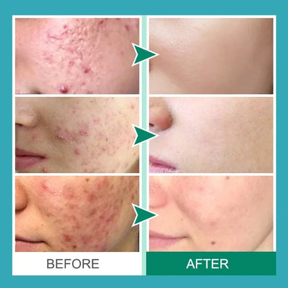 Salicylic Acid Acne Removal Cream – Anti-Acne, Redness Repair, Deep Cleaning & Oil Control Skincare