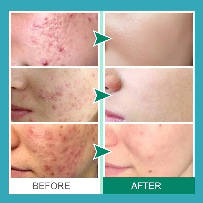 Effective Acne Removal Cream – Anti-Acne Gel for Redness, Pimples, Deep Pore Cleaning & Oil Control Skin Care