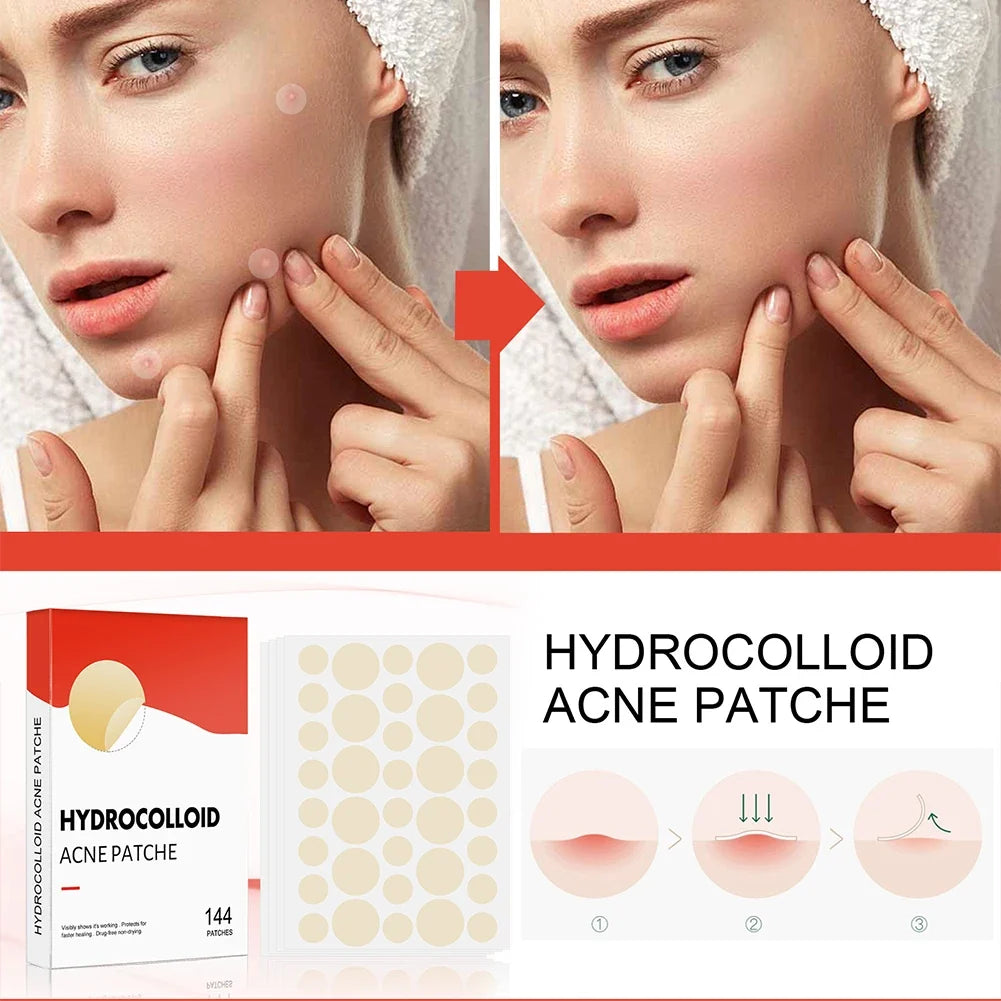 144PCS Acne Pimple Patch Set – Invisible Hydrocolloid Spot Stickers for Face Care & Healing (Men & Women)