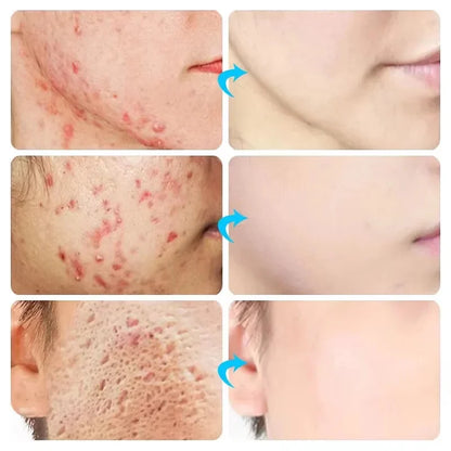 Effective Acne Removal Cream 30g – Anti-Acne Gel for Redness, Pimples, Deep Pore Cleaning & Oil Control Skin Care
