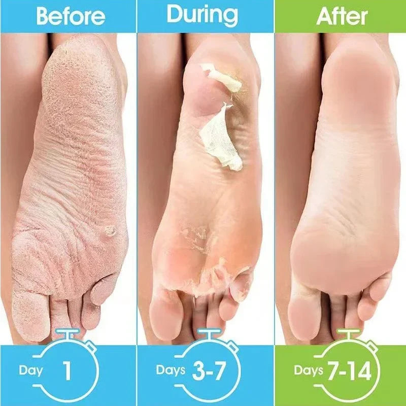 Honey Foot Mask – 1 Pair for Dead Skin & Callus Removal, Exfoliating Foot Treatment, Whitening Foot Spa & Skin Care Tool