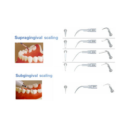 5 Work Tips Woodpecker G1, G2, G3, G4, P1 for Dental Cleaning – Woodpecker Dental Tools