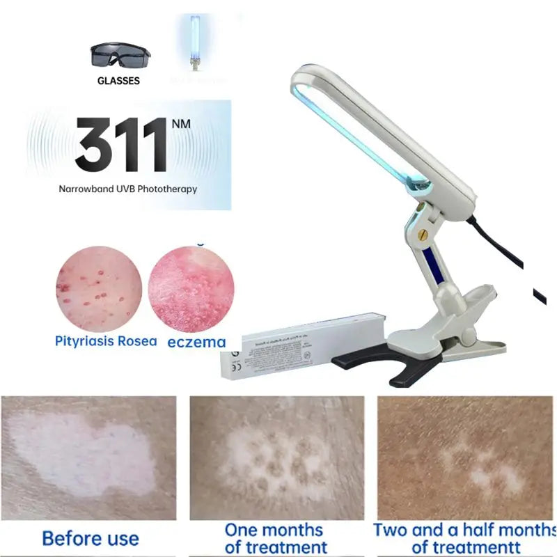 UV 311nm Phototherapy Device – Philips UVB Lamp for Vitiligo, Psoriasis & Skin Treatment