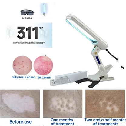 UV 311nm Phototherapy Device – Philips UVB Lamp for Vitiligo, Psoriasis & Skin Treatment