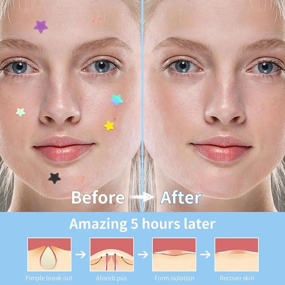 Colorful Star Pimple Patches – Invisible Acne Spot Stickers for Skin Care, Concealer & Makeup Tools