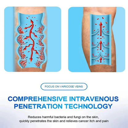 Varicose Vein Therapy Lamp — Improves Blood Circulation & Relieves Leg Phlebitis