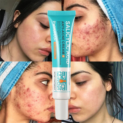 Effective Acne Removal Cream – Anti-Acne Gel for Redness, Pimples, Deep Pore Cleaning & Oil Control Skin Care