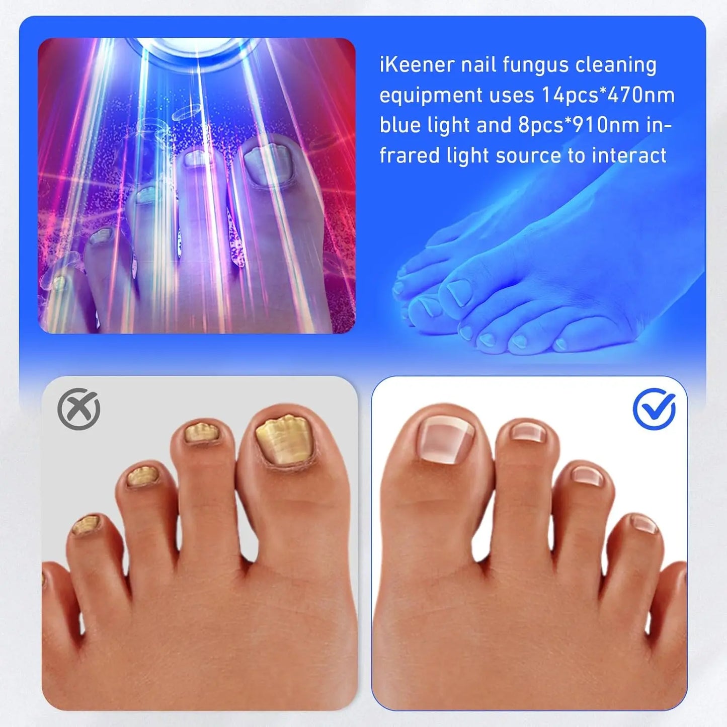Wireless Toenail Fungus Laser Treatment Device – 470nm & 910nm Blue Light Anti-Fungal Therapy Tool