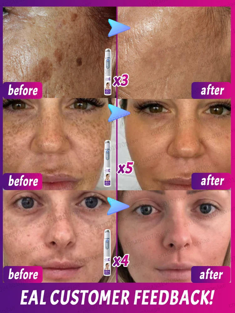 Freckle & Dark Spot Removal Treatment – Fade Chloasma, Age Spots, Acne Marks & Sun Spots