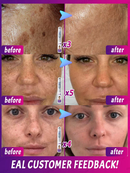Freckle & Dark Spot Removal Treatment – Fade Chloasma, Age Spots, Acne Marks & Sun Spots