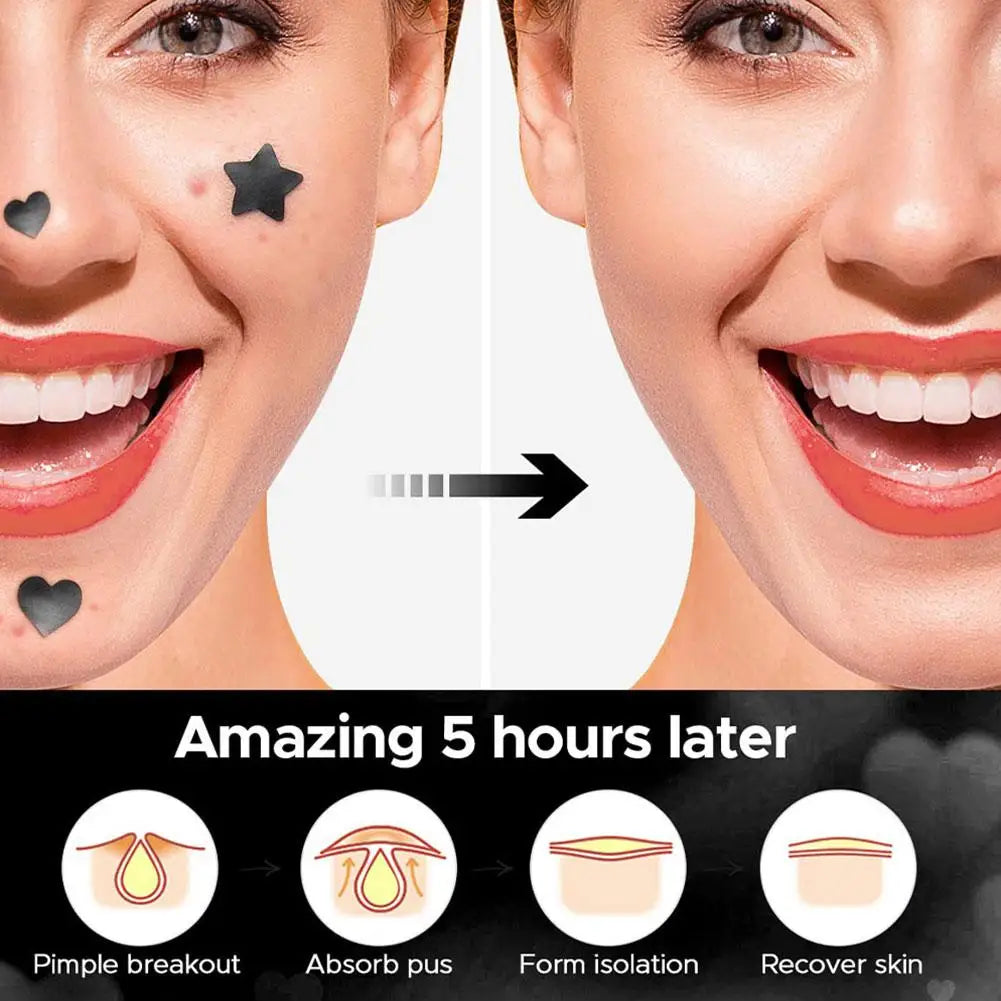 Colorful Star Pimple Patches – Invisible Acne Spot Stickers for Skin Care, Concealer & Makeup Tools