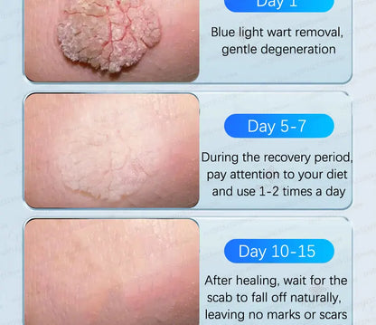 Safe Skin-Friendly Wart Removal Methods – Gentle Solutions for Effective Wart Treatment
