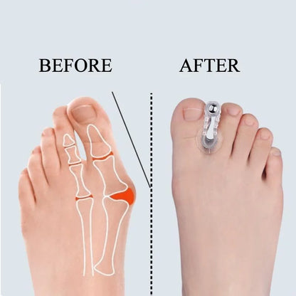 Bunion Toe Correctors - 2-Piece Hallux Valgus Spacers for Toe Alignment & Foot Care
