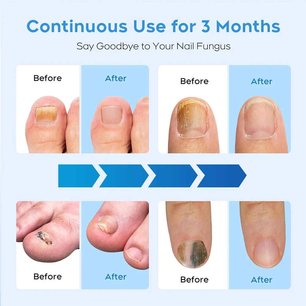 2-in-1 Fungal Nail Laser Device – Fast Repair for Toenail & Fingernail Fungus, Onychomycosis Treatment & Foot Care